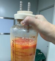 阿克苏水动力吸脂手术要做多久？